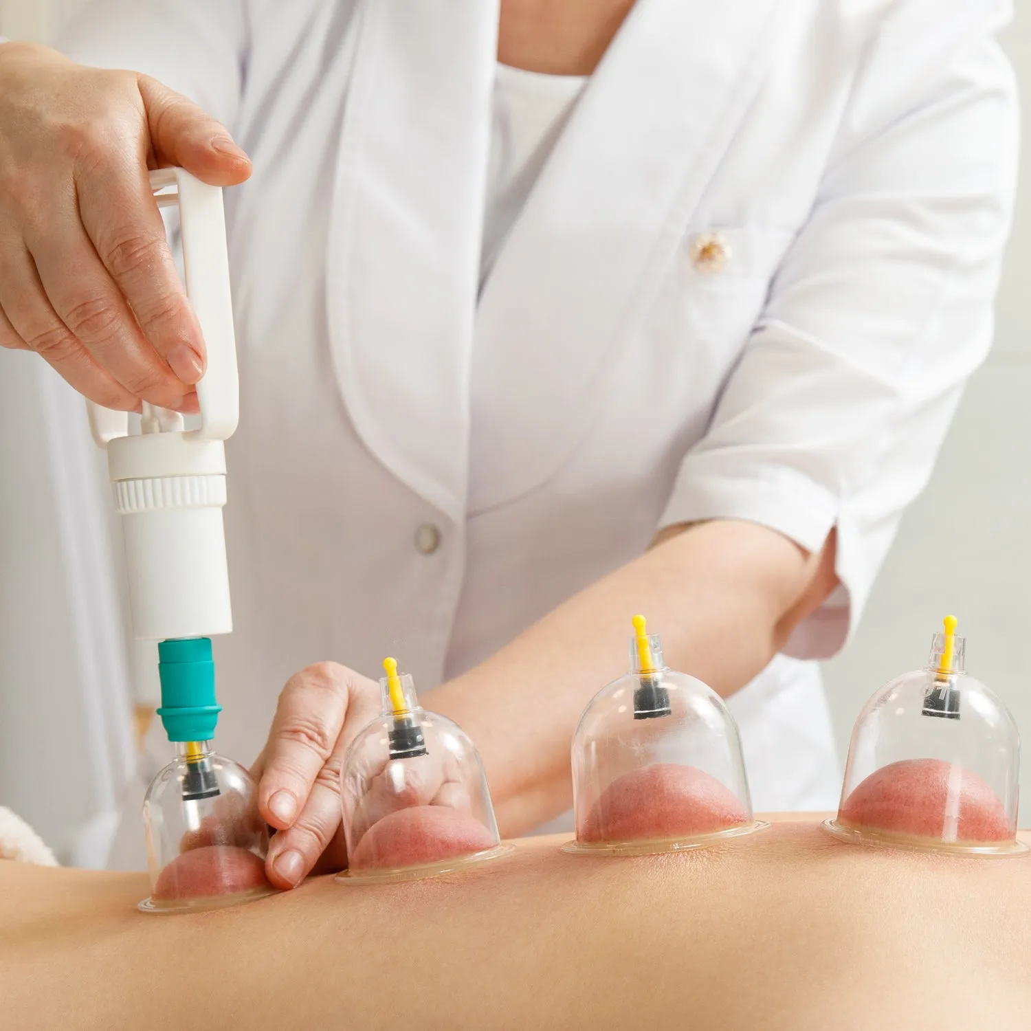 6 Pc Vacuum Cupping Therapy Set - Suction Pumps