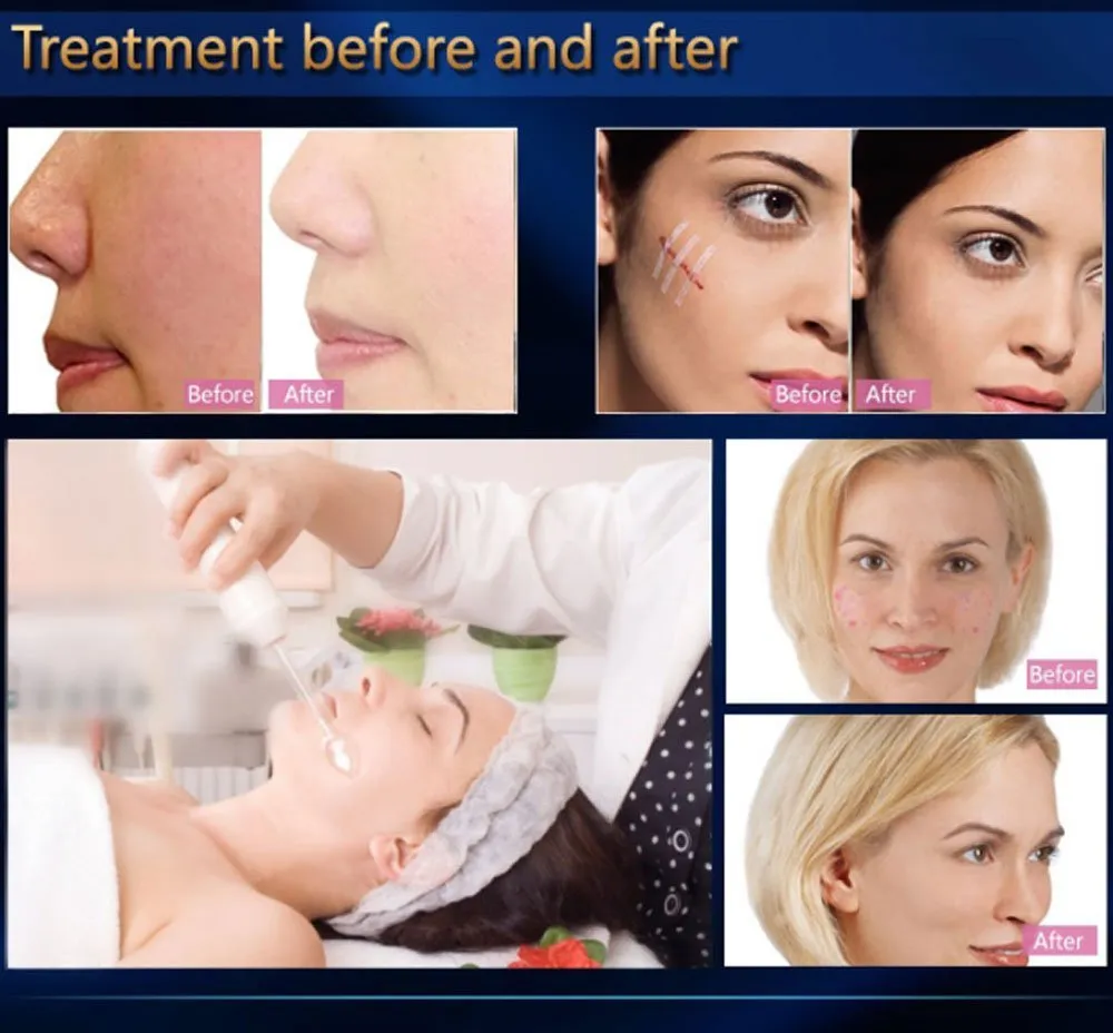 Portable Handheld High Frequency Facial Machine